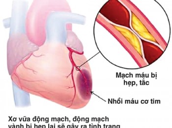 Nitroglycerin trong điều trị bệnh tim mạch, những điều cần biết